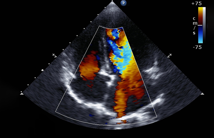 ecocardiograma2